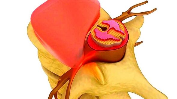 Thoracic spinal osteochondrosis.The essence of the disease