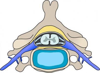 Protabius in vertebrae with cervical osteochondrosis