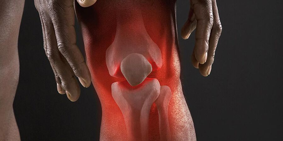 The burning sensation in the knee area is a symptom of gonarthrosis