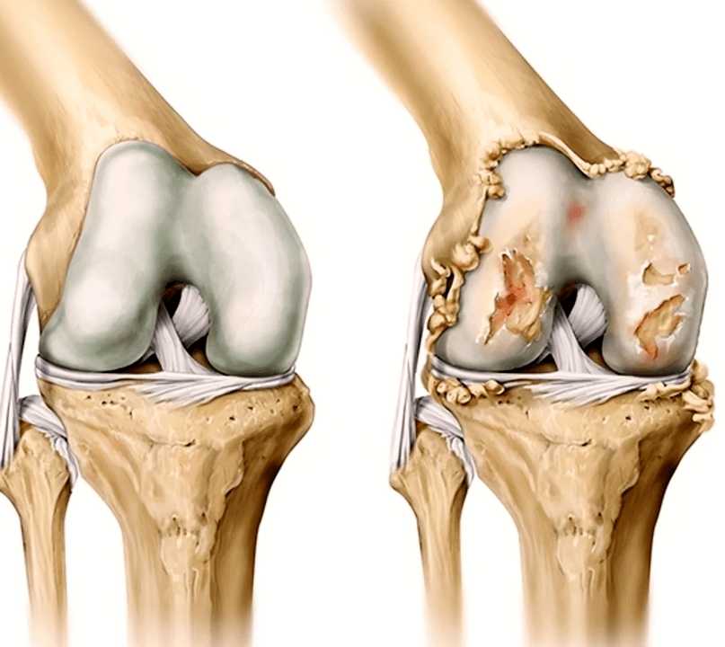 painful and healthy joints after using Artovitel gel